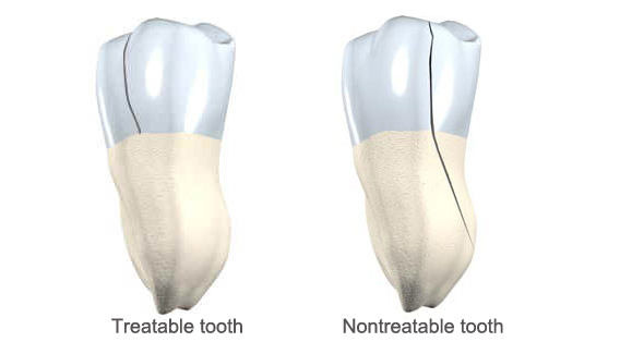 tooth cracked syndrome teeth crack pain nechupadam treat