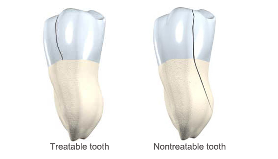 Fixing Cracked Teeth in Ottawa and Streator, IL