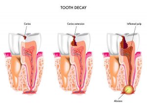 dental caries treatment