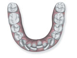 Crowded Teeth Invisalign Dentist Epping Dentist