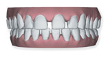 Gaps in Teeth Invisalign Dentist Epping Dentist