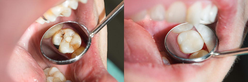Composite Resin Fillings Epping Dentist Epping