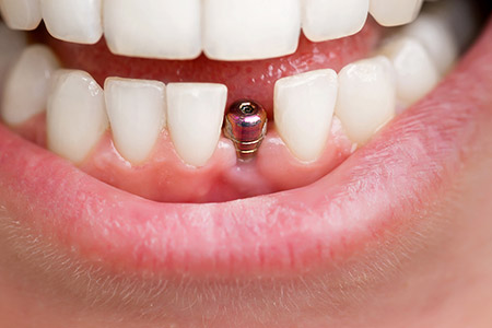 Dental Implant