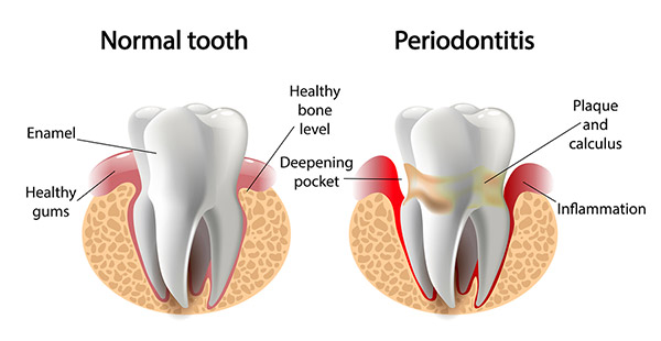 Gum Disease Epping Dentist Epping