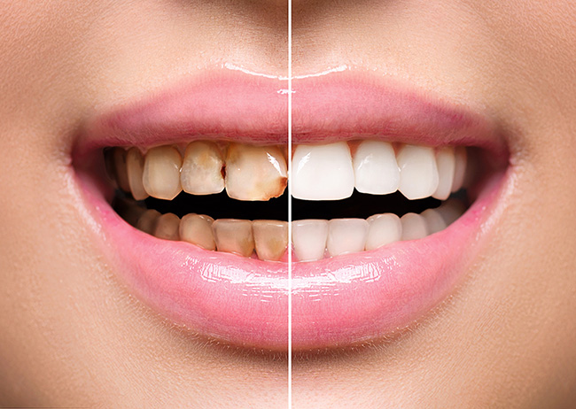 Tooth Whitening Best Dentist Epping Dentist