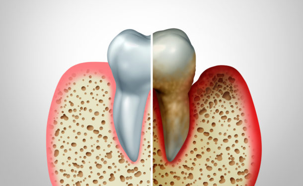 Periodontal Disease