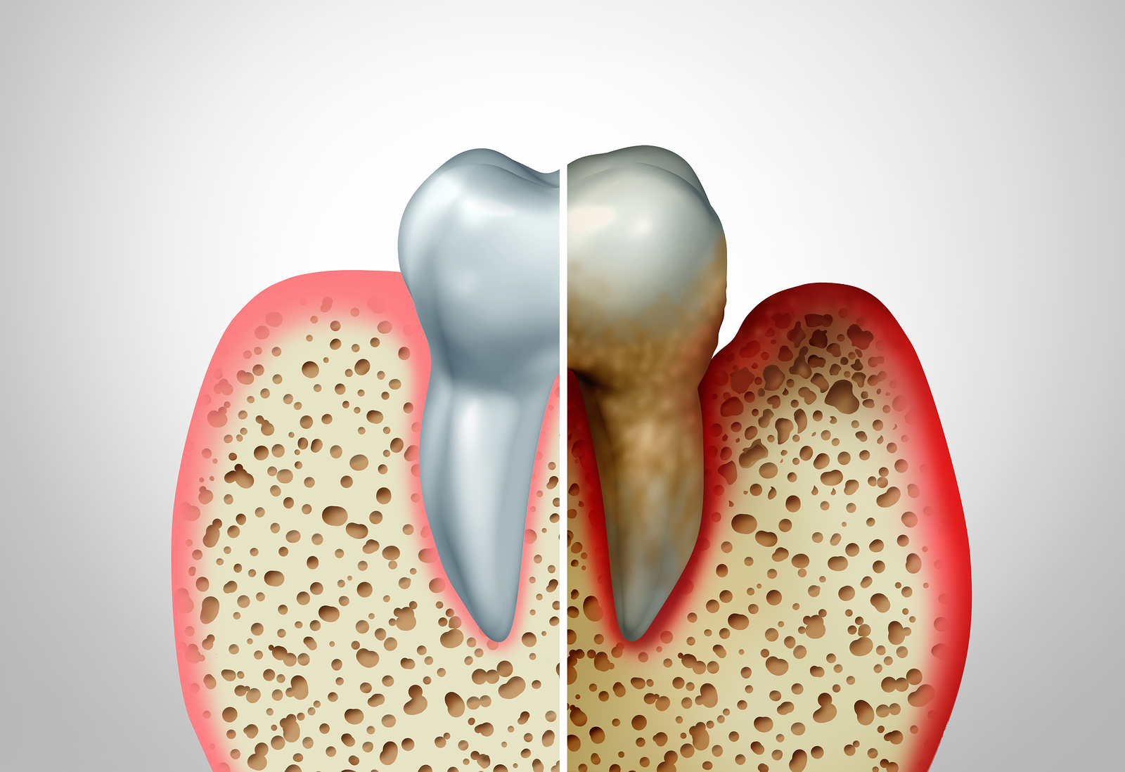 Obesity and Periodontal Disease