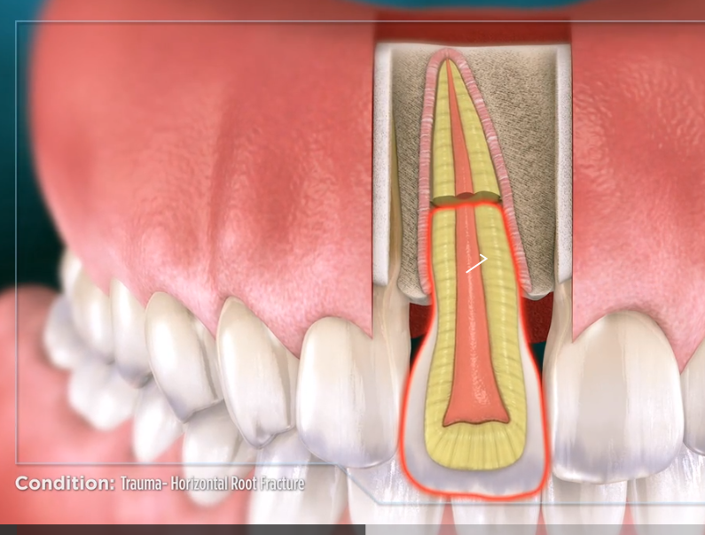 fracture tooth horizontal dental rawson