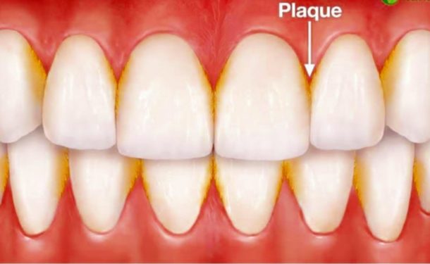 Plaque and calculus - Rawson Dental