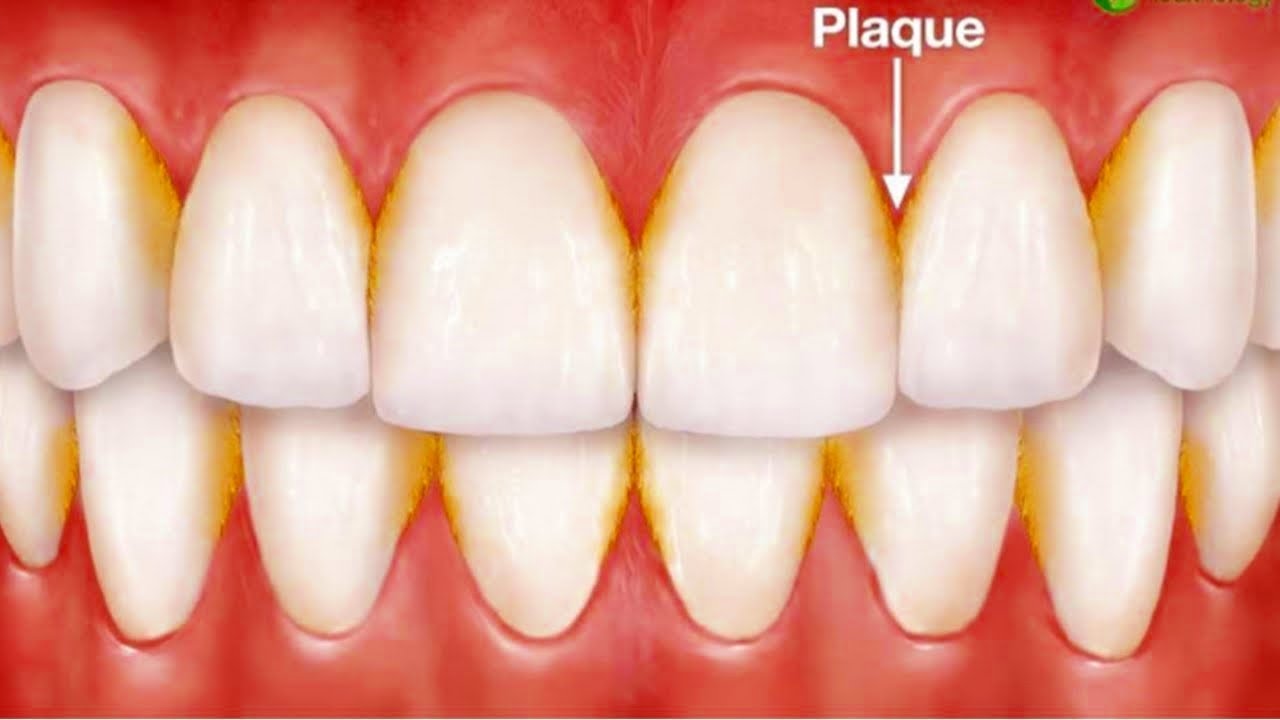 Plaque and calculus - Rawson Dental